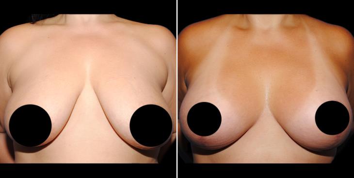 Before & After Mastopexy