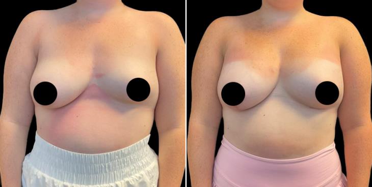 Breast Enhancement With Lift
