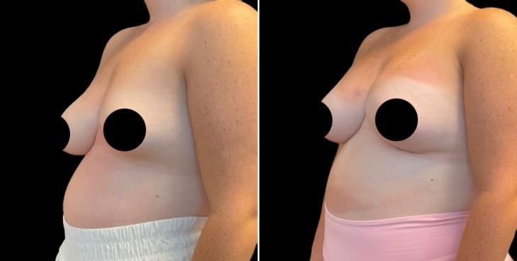 Atlanta Breast Enhancement With Lift