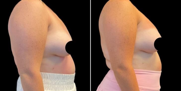 Breast Enhancement With Lift Surgery Atlanta 
