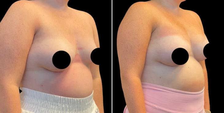 Breast Enhancement With Lift Surgery