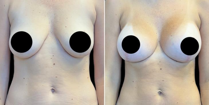 Atlanta Breast Enhancement With Lift Surgery