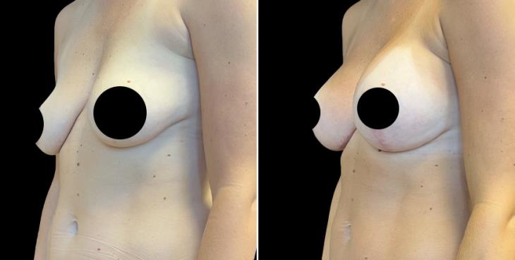 Results Of Breast Enhancement With Lift