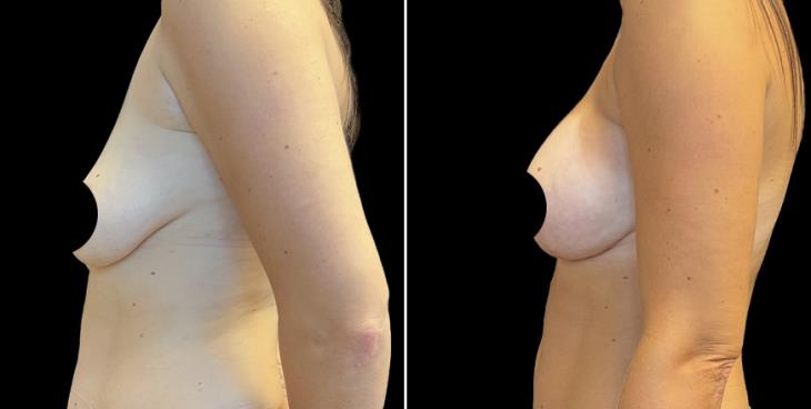 Breast Enhancement With Lift Results