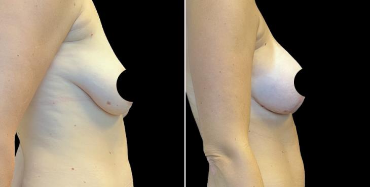 Atlanta Breast Enhancement With Lift Results