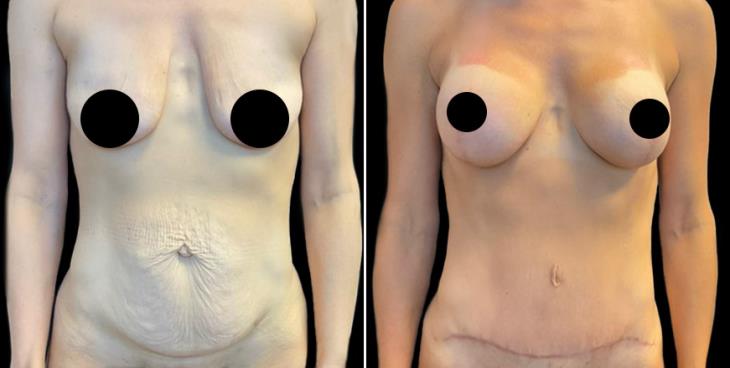 Breast Enhancement With Lift Results Atlanta GA