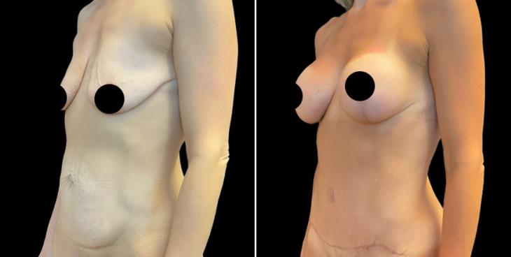 Breast Enhancement With Lift Results Atlanta Georgia