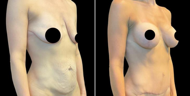 Atlanta Georgia Breast Enhancement With Lift Results