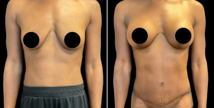 Breast Enhancement With Lift Before And After