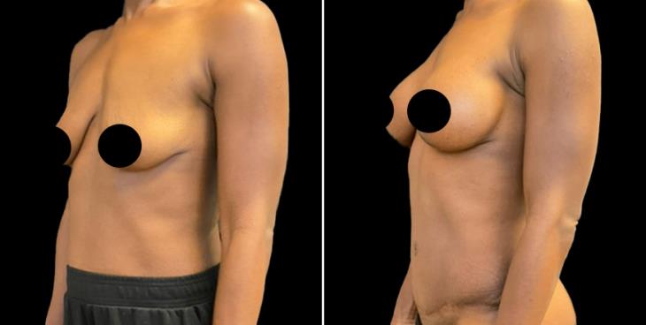 Before & After Breast Enhancement With Lift