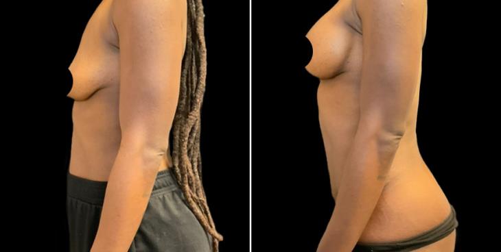 Breast Enhancement With Lift Before & After
