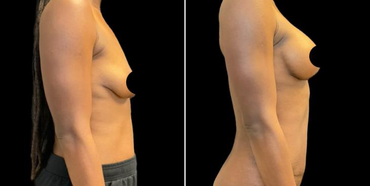 Atlanta Breast Enhancement With Lift Before & After