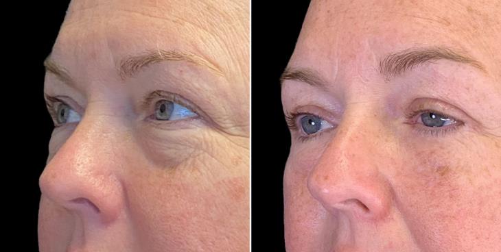 Eyelid Surgery Before And After