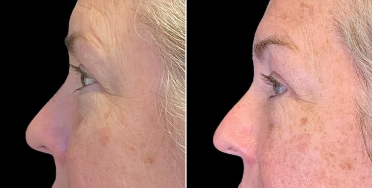 Eyelid Surgery Before & After