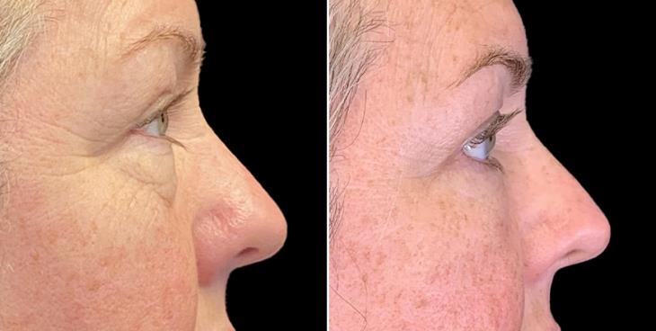 Before And After Eyelid Surgery Atlanta