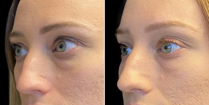 Before And After Eyelid Surgery Atlanta GA