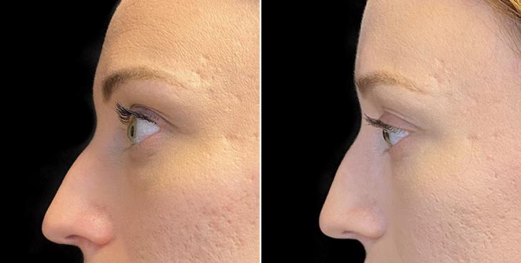 Atlanta GA Before And After Eyelid Surgery