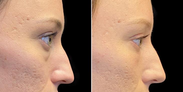 Atlanta GA Before & After Eyelid Surgery