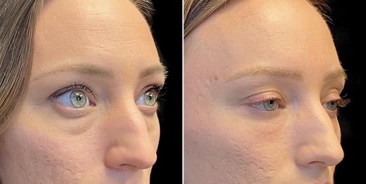 Before & After Eyelid Surgery Atlanta GA