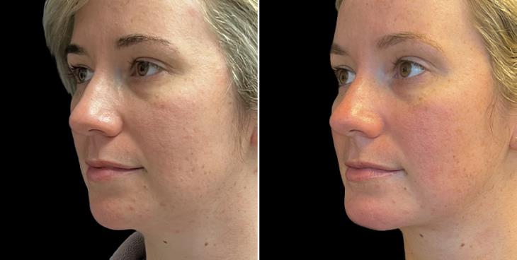Results Of Chin Implant & Facial Lipo