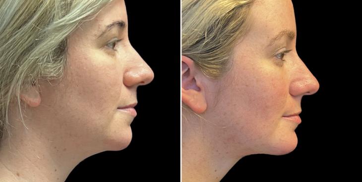 Facial Lipo & Chin Implant Results Atlanta