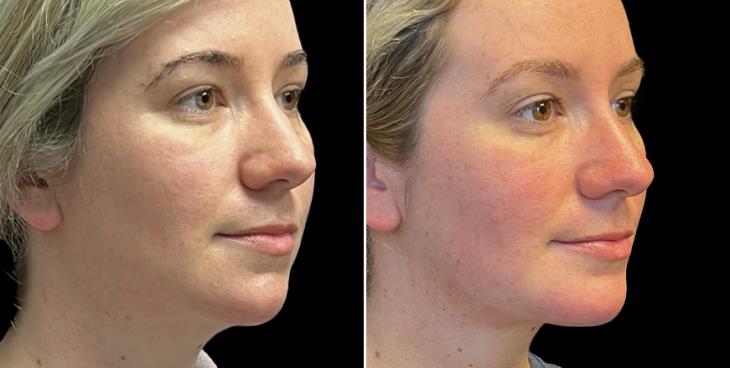 Facial Lipo & Chin Implant Results GA