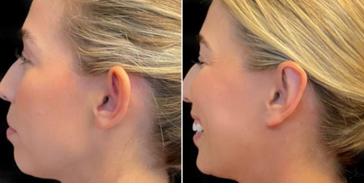 Results Of Ear Reduction Surgery