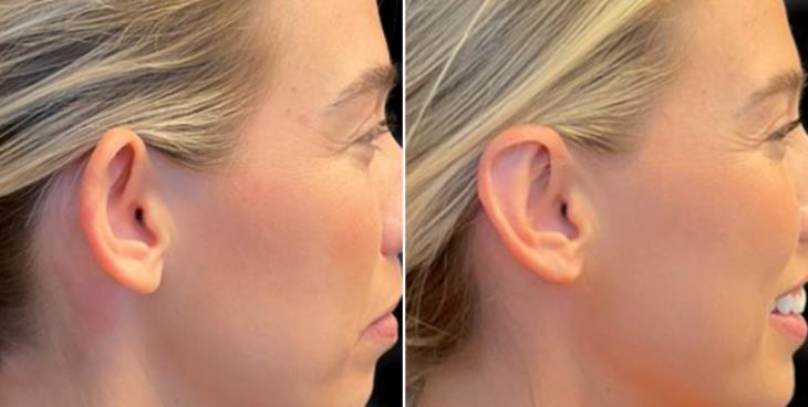Ear Reduction Before & After