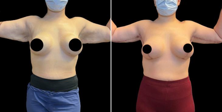 Atlanta Arm Lift Surgery