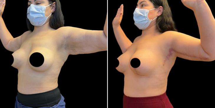 Atlanta GA Arm Lift Surgery