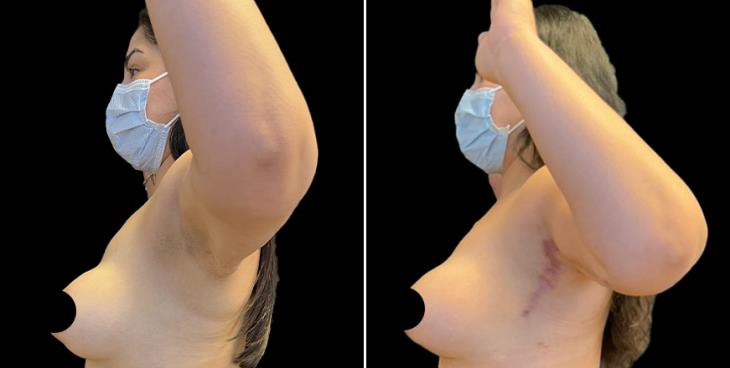Arm Lift Surgery Atlanta GA