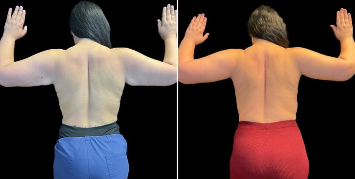 Arm Lift Surgery Atlanta