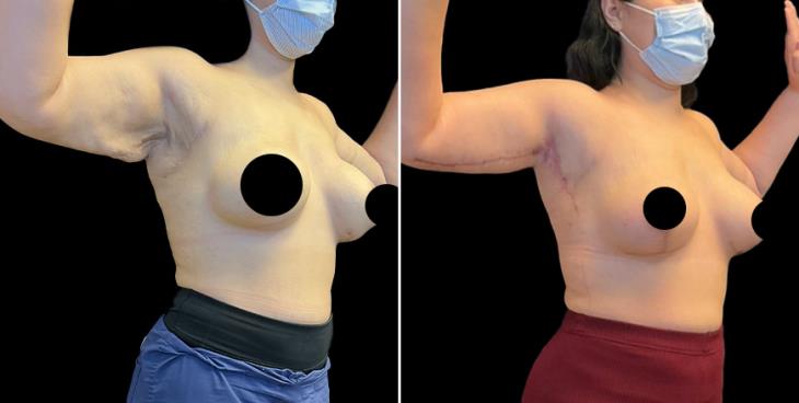 Arm Lift Surgery Atlanta Georgia