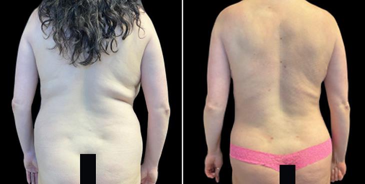 Marietta Abdominoplasty Surgery