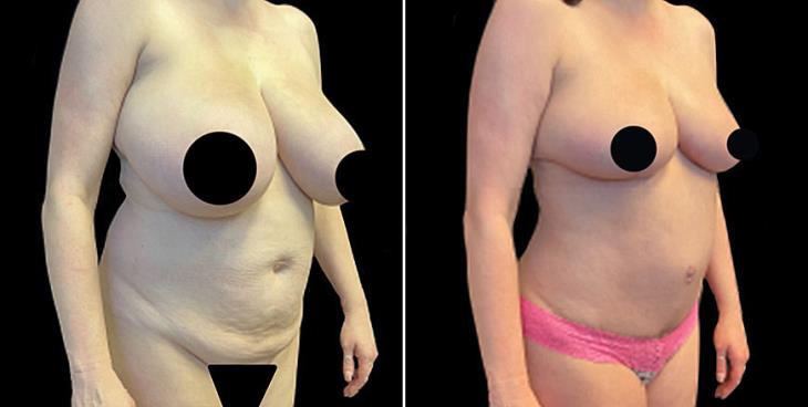 Cumming Abdominoplasty Surgery