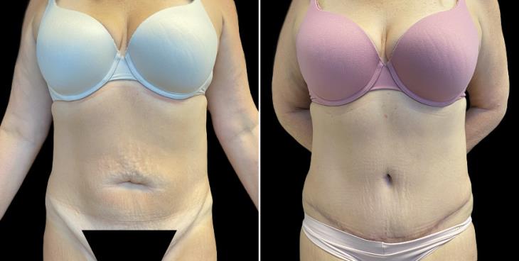 Abdominoplasty Surgery Atlanta, Tummy Tuck