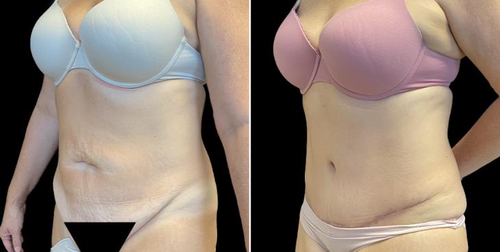 Abdominoplasty Surgery Atlanta