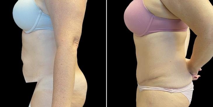 Atlanta Abdominoplasty Surgery