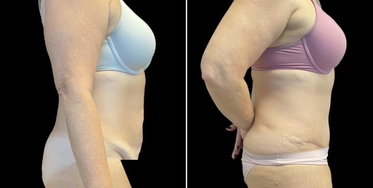 Atlanta GA Abdominoplasty Surgery