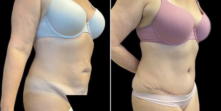 Abdominoplasty Surgery Atlanta GA