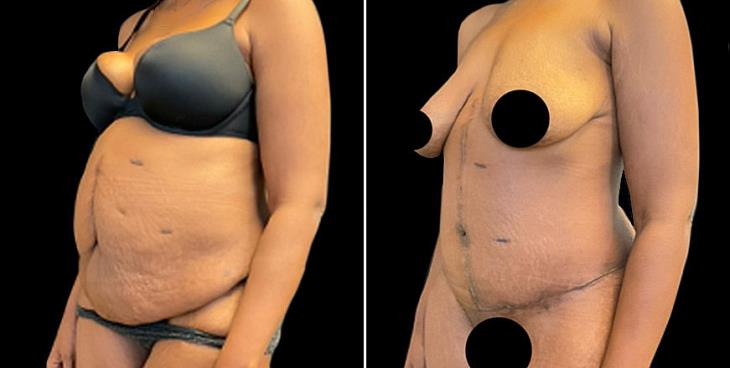 Abdominoplasty Surgery Marietta Georgia