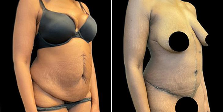 Marietta GA Abdominoplasty Surgery