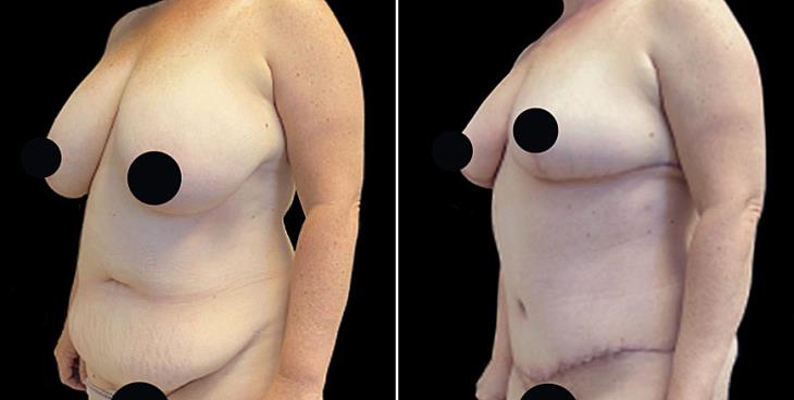 Abdominoplasty Surgery Marietta GA