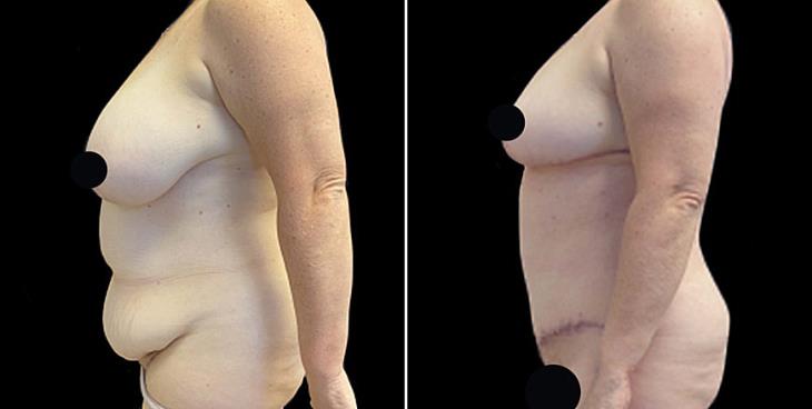 Abdominoplasty Surgery Results