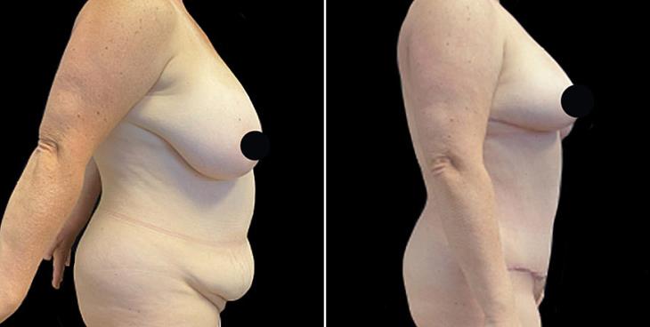 Stomach Tuck Surgery Before & After