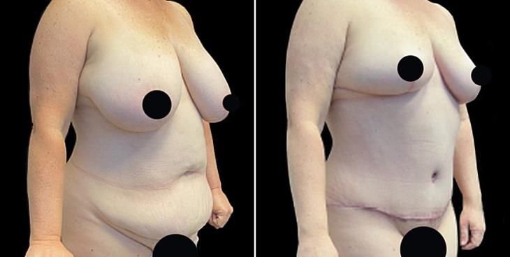 Results Of Abdominoplasty Surgery