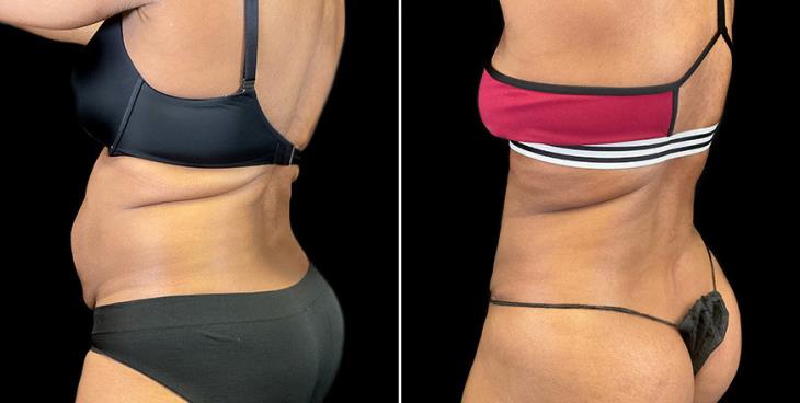 Lipo 360 Results ¾ Back View Atlanta