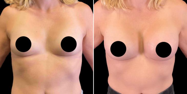 Saline Breast Implants