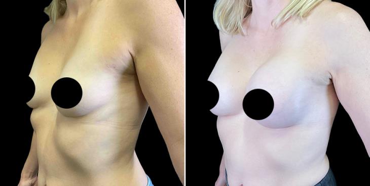 Saline Breast Implants ¾ View