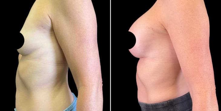Saline Breast Implants Side View